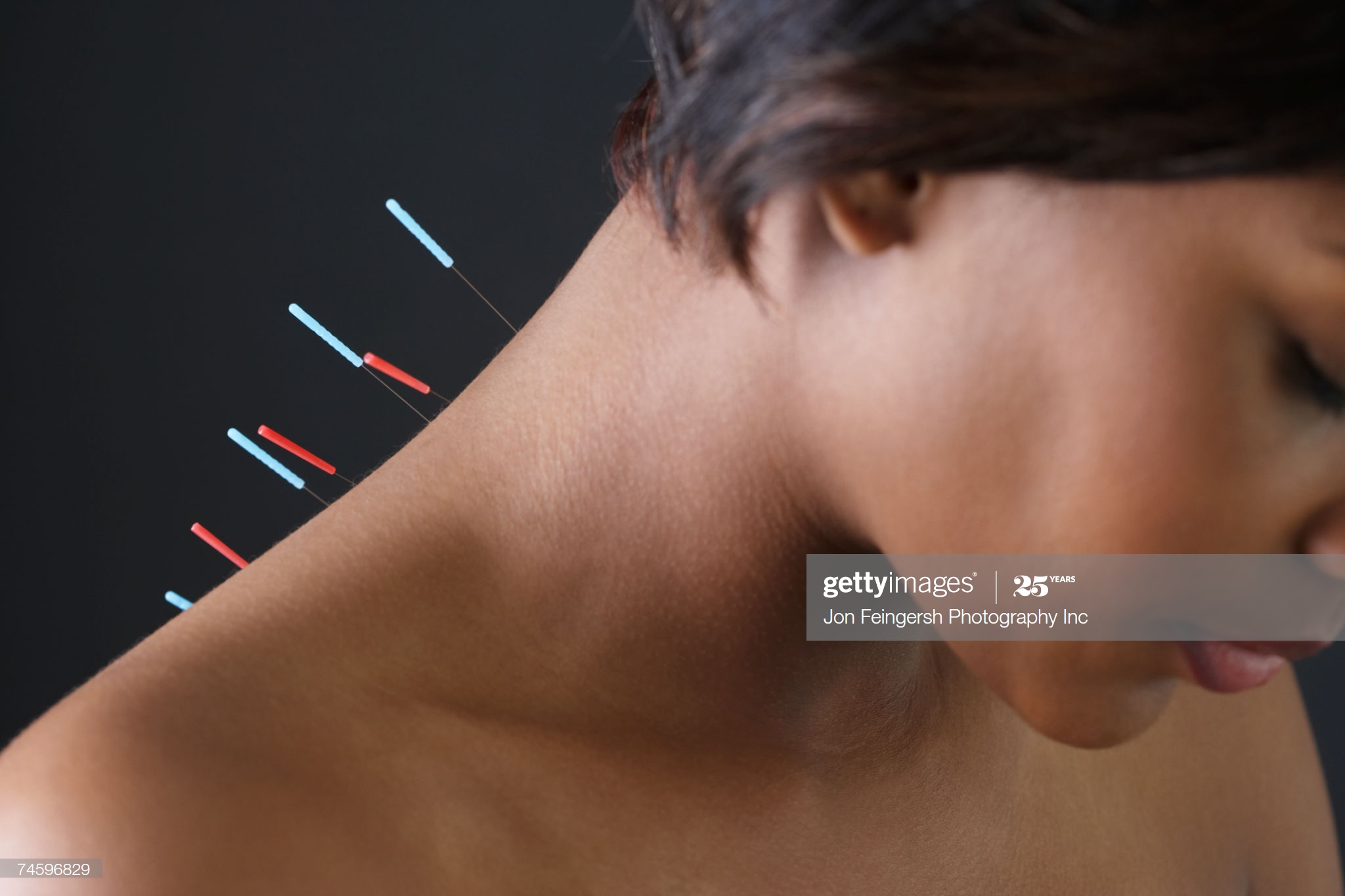 Acupuncture et besoins des femmes atteintes de fibromes